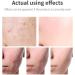 acne removal cream Acne Scar Removal Gel Face Body Marks Skin Repair Cream Acne Treatment Essence 30g - Buy Online on GoSupps.com
