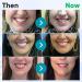 Neslemy Gum Shield Therapy Gel & Lovild's Gum Therapy Gel - Intensive Stain Removal & Tooth Bumpers (4PCs) | Shop Internationally - Buy Online on GoSupps.com