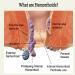 Hhkuize Heca Natural Herbal Hemorrhoid Capsules - Fast Relief (2 Box) - Buy Online on GoSupps.com