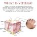 DUBUSH Vitiligo Removal Relief Spray - Skin Repair for Face and Body (3pcs) - Buy Online on GoSupps.com