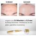 Koi Beauty Dermaroller - 192 Real Needles 0.5mm for Professional Microneedling Hair & Beard Growth at Home | Best Derma Roller for Scalp Face & Body - Buy Online on GoSupps.com