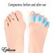 6 Pieces Gel Toe Separators - Bunion Corrector & Toe Alignment Spacers for Pain Relief | Blue - Buy Online on GoSupps.com