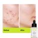 Pure Salicylic Acid & Tea Tree Face Serum - Acne Prevention Pore Reduction Anti-Aging & Exfoliating Treatment - Buy Online on GoSupps.com