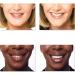 MXRFACTORY Snap-On Dental Veneers - Reusable Braces for Missing Teeth (4 Pairs) | Cosmetic Solutions for Upper & Lower Jaw - Buy Online on GoSupps.com