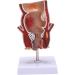 Anatomy Model: Human Rectal Lesion Fistula & Fissure Pathology - Ideal for Teaching | International Shipping - Buy Online on GoSupps.com