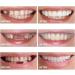 2 Pairs Temporary Nature and Comfortable Adjustable for Men and Women Beautiful Smile(White) (4) - Buy Online on GoSupps.com
