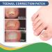 Professional Nail Patches for Ingrown Toenail Corrector - 50PCS - Buy Online on GoSupps.com