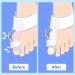KOTALS Bunion Corrector Brace Splint Pads & Toe Separators - White (1 Pack) - Buy Online on GoSupps.com