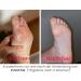 FUSSFAIR Callus Remover Balm Cream - Natural 30ml Callus Removal Solution | Softens Feet & Heels - Buy Online on GoSupps.com