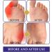 Mimimachi Anti-Ballenzeh Plaster - Strong Joints Bunion Cushion Pads for Hallux Valgus & Overlapping Toes - Natural Pain Relief - 3 Box Set - Buy Online on GoSupps.com