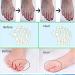 ENPAP 24H Corrector Toe Separator for Men and Women - Shoe Friendly Solution - Buy Online on GoSupps.com