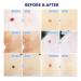 TAGRID Skin Tag Remover  Skin Tag Remover Device for Small to Medium (2mm -5mm) Skin Tags(40x Removal Bands & Cleansing Wipes) 02 - Buy Online on GoSupps.com