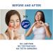 KOHEEL Adjustable Bite Guard for Bruxism - Nighttime Teeth Grinding Relief | Pack of 4 - Buy Online on GoSupps.com