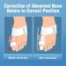 Bunion Corrector Toe Straightener | Adjustable Bunion Splint for Hallux Valgus Correction | Orthopedic Supplies for Bunion Relief - Buy Online on GoSupps.com