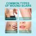 VOIV Scar Remover Spray 20g 5pcs - Relieves Itching, Removes Dark Acne - Dermatologist Recommended for All Types of Scars - Buy Online on GoSupps.com