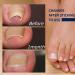 Toenail Correction Patch 100PCS - Professional Ingrown Toenail Corrector Strips for Foot Care - Health Toenail Treatment Tool for Glue-Free Nail Correction - Blue - Buy Online on GoSupps.com