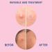 Buy Acne Patches - Invisible Hydrocolloid Spot Stickers for Fast Healing | 108 Translucent Pimple Patches Two Sizes Available - International Shipping - Buy Online on GoSupps.com