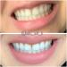 Smile Sciences Teeth Whitening Ultra Red & Blue LED Light - Effective International Shipping Available - Buy Online on GoSupps.com