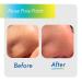 FAZIT Zit Zapper Nose Pore Patch - 10-Pc Hydrocolloid Acne Remover for Blackheads - Overnight Blemish Treatment Patches - Best Pore Strips for Clear Skin - Buy Online on GoSupps.com