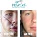 NewGel+E Advanced Silicone Scar Treatment Gel - 15g for Old & New Scars, Surgery, Injury, Keloids, Burns, Acne - With Vitamin E - Buy Online on GoSupps.com