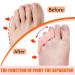 Pesalmon 8-Pack Pinky Toe Separators for Overlapping Toes - Gel Little Toe Spacers for Toe Separation and Protection (Beige) - Buy Online on GoSupps.com