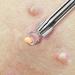 Beaute Galleria Blackhead & Pimple Extractor Tool for Acne & Blemish Removal - Buy Online on GoSupps.com