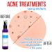 Topical Probiotic Spray for Skin - 13 Live Strains | Skin Care for Acne, Folliculitis, Dermatitis, Rosacea, Eczema | Body & Face Mist Deodorant - Buy Online on GoSupps.com