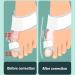 Lmeil Bunion Orthoses - Big Toe Straightener & Corrector | Hallux Valgus Relief for Men & Women - Buy Online on GoSupps.com