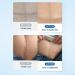Medical Grade Silicone Scar Sheets - Surgical Scar Tape for C-Section Tummy Tuck Keloid Treatment - Buy Online on GoSupps.com