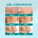 Scar Remove Advanced Spray - Eliminate Old, Pimple, and Stretchmark Scars - 5Pcs - Buy Online on GoSupps.com