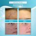  Anshka Organic scar removal gel natural scar therapeutic gel scar removal cream for old scars scar repair gel cream for men and women 1 piece - Buy Online on GoSupps.com