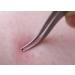 Best Faude Tick Pliers & Tweezers | Stainless Steel Tick Removal Tool - 12.5cm No Squeeze Design - Buy Online on GoSupps.com