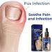 Lovelycat remove ongulite huile anti ongulite apaisante huile ongle ongle croissance huile soin des ongles pour les pieds et les mains en bonne sant Nourishing Inlet ongle traitement huile (2PC-1) - Buy Online on GoSupps.com