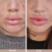 Australian Bodycare Face Cream 50ml | Tea Tree oil + Lemon Myrtle | Moisturiser spot treatment pimple oily acne prone skin. Tea Tree Cream Face Moisturiser. Spot Cream and anti blemish moisturiser - Buy Online on GoSupps.com