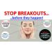 V88 MAX Breakout Cream DOUBLE STRENGTH with Salicylic Acid for Spots Blackheads Blemishes and Problem Skin Suitable and Safe for those Prone to Acne - Paraben and Cruelty FREE - 50 grams - Buy Online on GoSupps.com