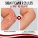 LELEBEAR Dermax Psoriasis Treatment Spray - Soothes Skin, Stops Burning and Itching (5 Pack) - Buy Online on GoSupps.com