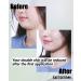 V Shaped Slimming Face Mask | Lifting Patch Hyaluron for Double Chin Reduction & V Line Care - International Shipping - Buy Online on GoSupps.com