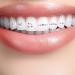 Shop Tartar Set | Stylish Jewelry for Teeth | DIY Edelstein Dental Decoration for a Radiant Smile - Buy Online on GoSupps.com