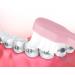 Wllhyf End Tuft Toothbrush Set - Soft Bristle Cleaning for Crowns Bridges & Implants | 4 Pack in White Pink Blue Green | Ideal for Hard-to-Reach Areas - Buy Online on GoSupps.com