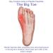 Big Toe Splint for Plantar Fasciitis Relief | Lightweight Toe Support Brace for Men & Women | Pain Solution for Flat Arches Achilles Tendonitis Heel Spurs & Foot Drop - Buy Online on GoSupps.com