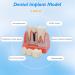 Dental Implant Model - 4 Times Removable Crown Bridge | Educational Teeth Model for Learning & Analysis - Buy Online on GoSupps.com