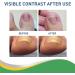 2 Pcs Ingrown Toenail Corrector | Foot Nail Corrector with Double-sided Adhesive Paste | 50pcs Toe Nail Corrector Non-Woven Fabrics Comfortable Toenail Tool Foot Care Klufo 2 Pcs 50pcs - Buy Online on GoSupps.com