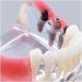 Dental Upper Implantate Model - Superior Overdenture Restoration for Education | Transparent Vision & Soft Gum - Ideal Study Tool - Buy Online on GoSupps.com