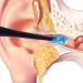 Waitlover Ear Wax Removal Kit - Ear Pick Cleaning Tools for Health - 1pc Curette Stick Cleaner - Buy Online on GoSupps.com