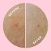 ZitSticka Hydrocolloid Body Patches - 9 Pack GOO GETTER | Effective Acne Treatment for Body Zits | Exfoliating & Moisturizing Blemish Patches - Buy Online on GoSupps.com