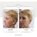 Best Anti-Aging Face Lift Serum - Award-Winning 2.5% Retinol with 11% Hyaluronic Acid, Vitamin C & E, Aloe Vera - 30ml - Buy Online on GoSupps.com