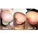 Probelle Natural Fungal Nail Gel - Restores Appearance of Discolored Nails - 3 Pack (15 mL/0.50 oz) - Buy Online on GoSupps.com