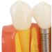 Verdant Touch Crown Bridge Demonstration Model - 4X Dental Implant Model for Doctor-Patient Education | International Shipping - Buy Online on GoSupps.com