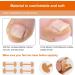 Ingrown Toenails Tool Set Toenail Correction Patch - Buy Online on GoSupps.com