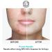 Acne Face wash Treatment with Benzoyl Peroxide 10% - Fight Acne Blemishes on Contact for Cystic Breakouts Oily Skin Clogged Pores Blackhead Whitehead & Pimples. Achieve Clear Skin. BPO 10% 6.8 FL Oz (Pack of 1) - Buy Online on GoSupps.com